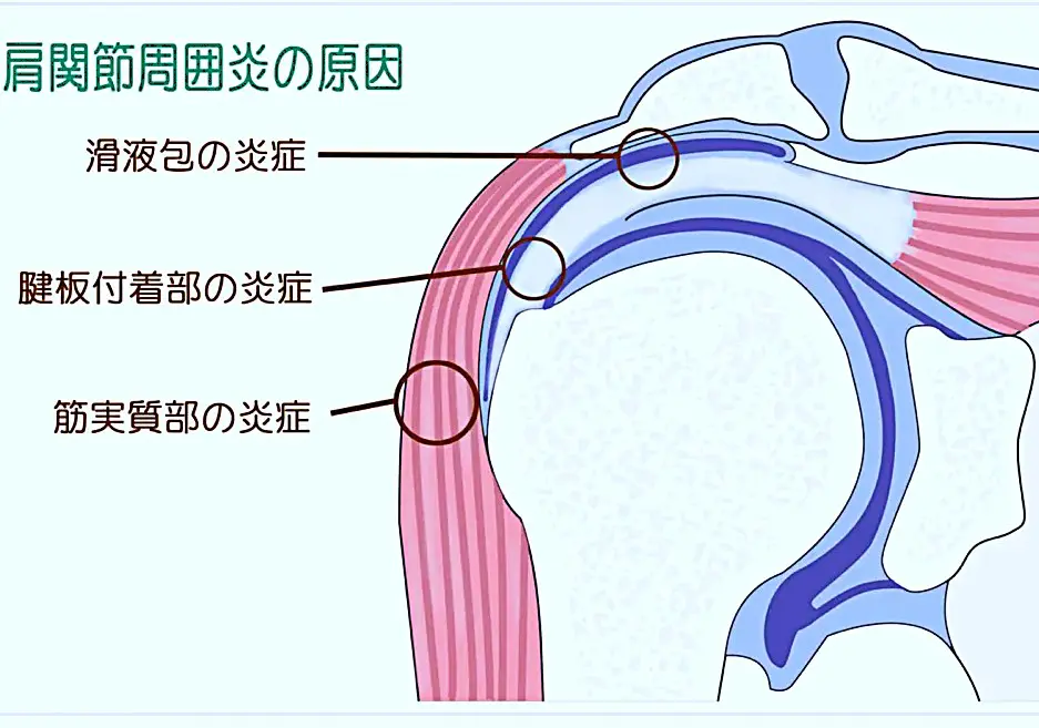 肩関節の極意 肩関節の極意 痛み編［痛みを発生させる